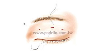 訂書針微創泡泡眼