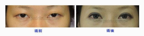 Case 1：訂書針微創泡泡眼 + 隱形提眼肌調整 + 韓式隆鼻