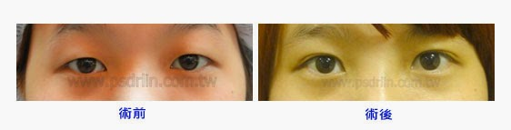Case 2：訂書針微創泡泡眼 + 開眼頭手術