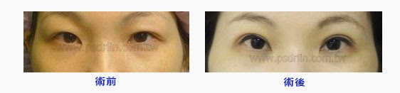 Case 3：訂書針微創泡泡眼手術（香港案例）