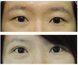 Case 7：訂書針微創泡泡眼 + 隱形提眼肌 + 開眼頭