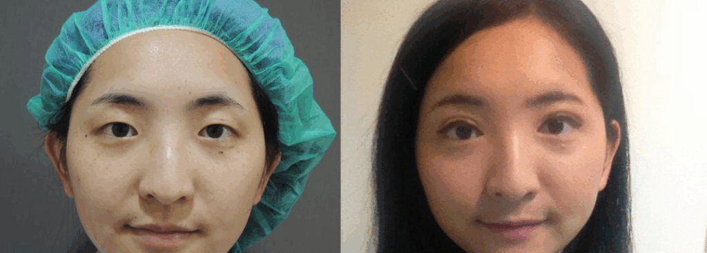 Case 8：訂書針微創泡泡眼手術