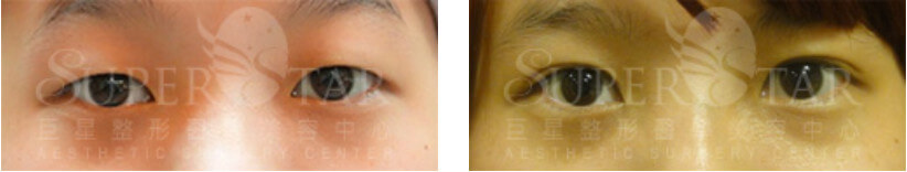 案例一（療程效果因人而異，圖片為該案例實際術後成效）