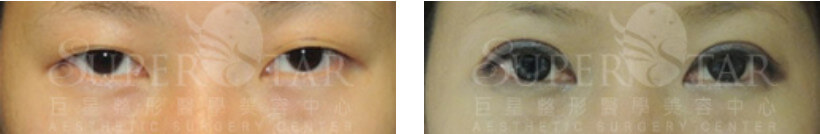 案例二（療程效果因人而異，圖片為該案例實際術後成效）