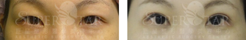 案例三(療程效果因人而異，圖片為該案例實際術後成效）