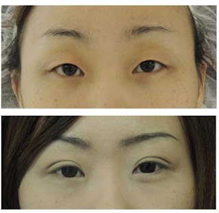 Case 1：2+1訂書針縫雙眼皮