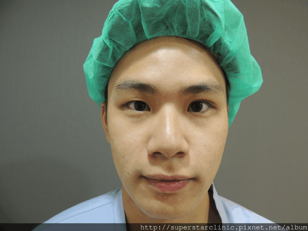 大小眼＋上眼皮脂肪厚(典型泡泡眼特徵)