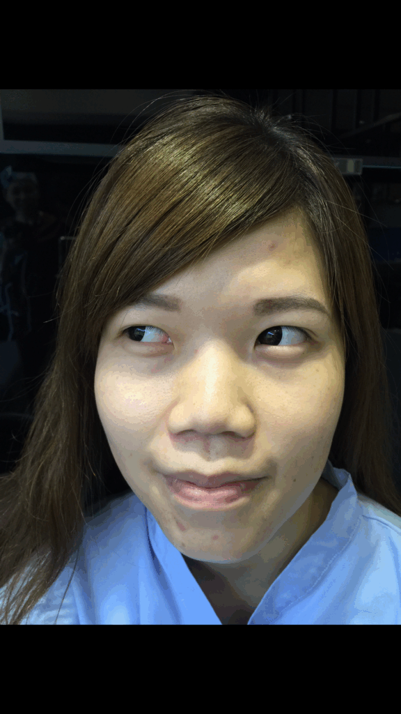 術前：鼻型較寬且塌，五官缺乏立體感