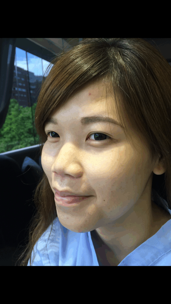 術前：鼻型較寬且塌，五官缺乏立體感