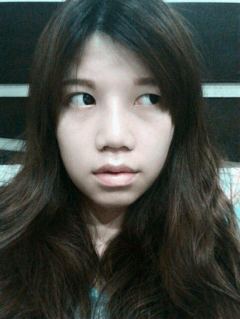 術後兩週：消腫迅速，鼻型自然顯著改善1