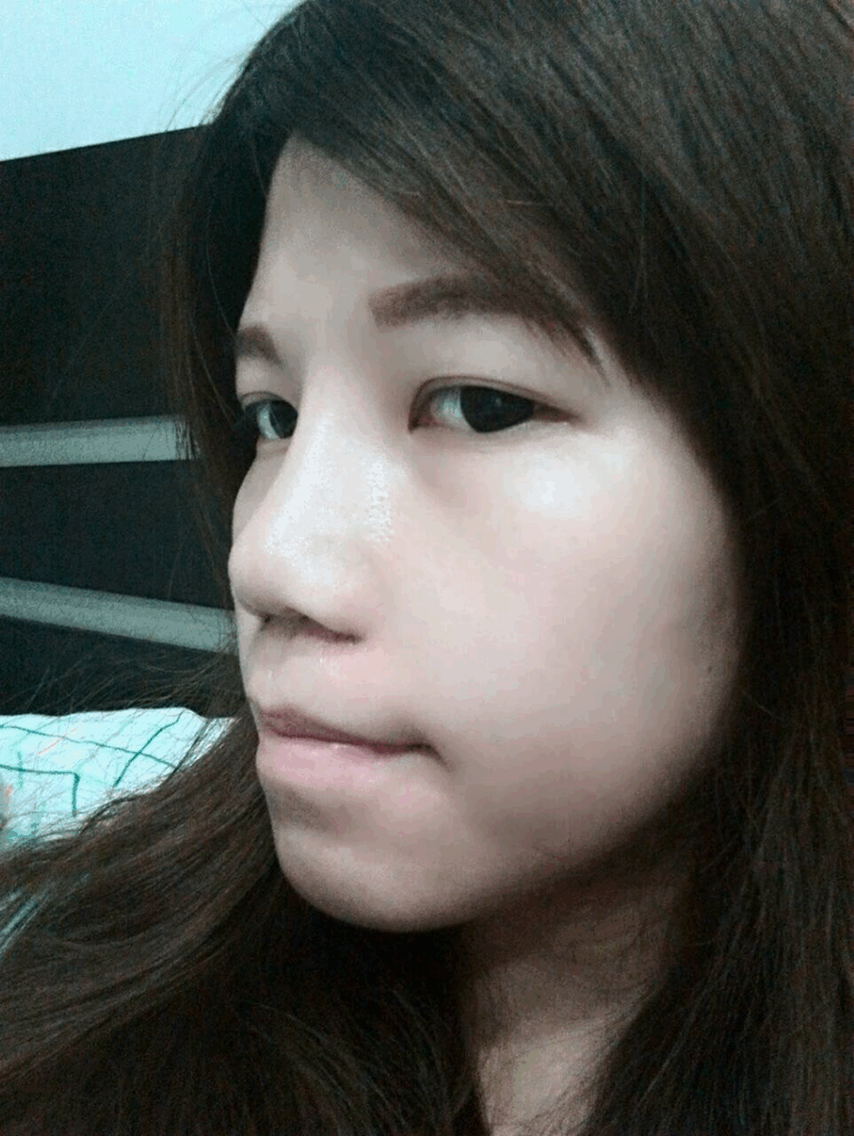 術後兩週：消腫迅速，鼻型自然顯著改善2