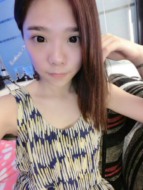 術前狀況：長期施打微晶瓷，導致山根擴散與扁塌2