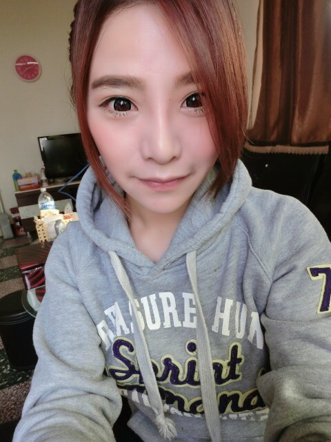 韓式隆鼻術後 14 天：消腫迅速，鼻頭縮小顯精緻1