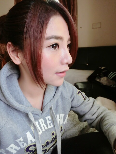 韓式隆鼻術後 14 天：消腫迅速，鼻頭縮小顯精緻2