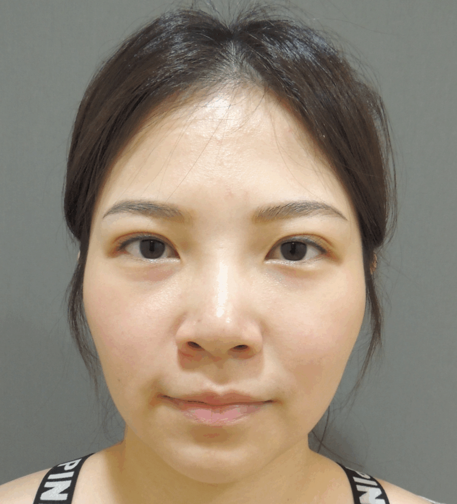 隆鼻術前：山根打不挺，鼻樑變寬且視覺歪斜1