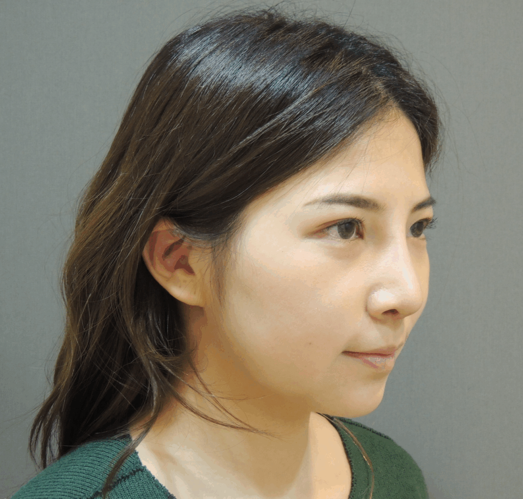 韓式隆鼻術後 7 天：微腫無瘀青，山根變挺、鼻翼視覺縮小1
