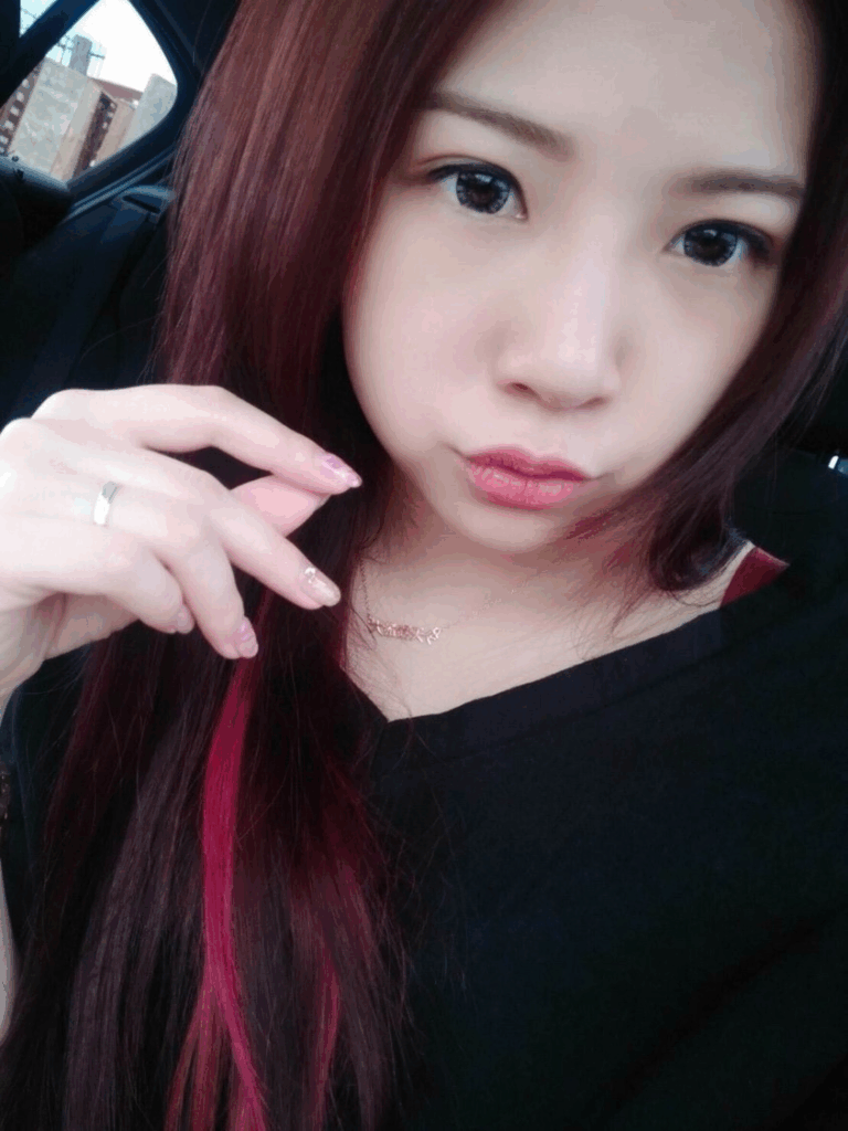 韓式隆鼻術後 3 個月對比：山根立體、五官精緻，打造零死角美鼻3