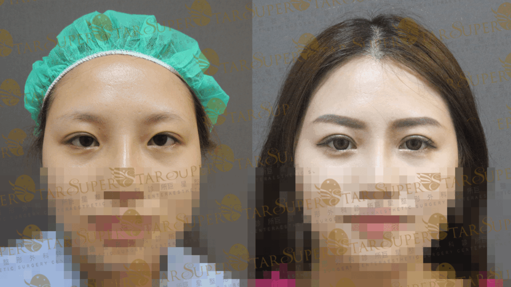 案例一：改善眼皮厚重感，眼神更明亮