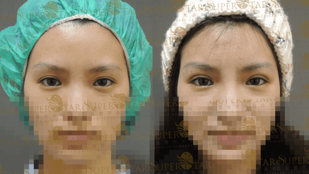 案例二：修除鬆弛贅皮，重塑雙眼皮折痕