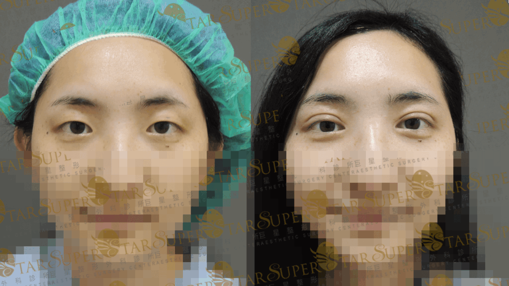 案例三：調整眼型不對稱，打造深邃眼神