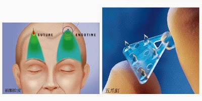 3. 內視鏡拉皮整形手術：解決眉壓眼的根本之道