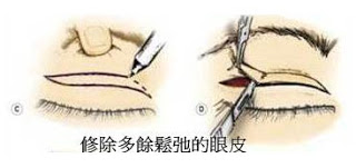 手術對策：老化性修眼皮手術