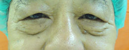2. 眉毛老化下垂 (Brow ptosis)