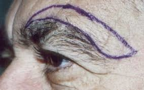 (1) 眉上提眉手術 (Direct Brow Lift)