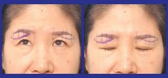 (2) 眉下提眉手術 (Sub-brow Lift)