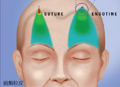(3) 內視鏡前額拉皮 (Endoscopic Forehead Lift) —— 黃金標準