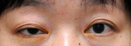 3. 眼瞼下垂 (Eyelid Ptosis) - 提眼瞼肌無力