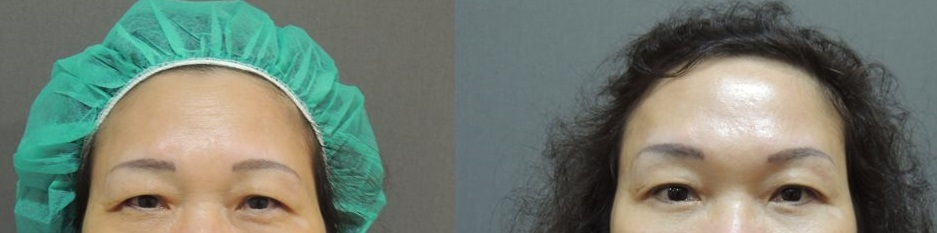 【成功案例分享】內視鏡前額拉皮