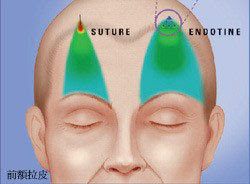 關鍵差異：為什麼選擇「五爪釘」固定？