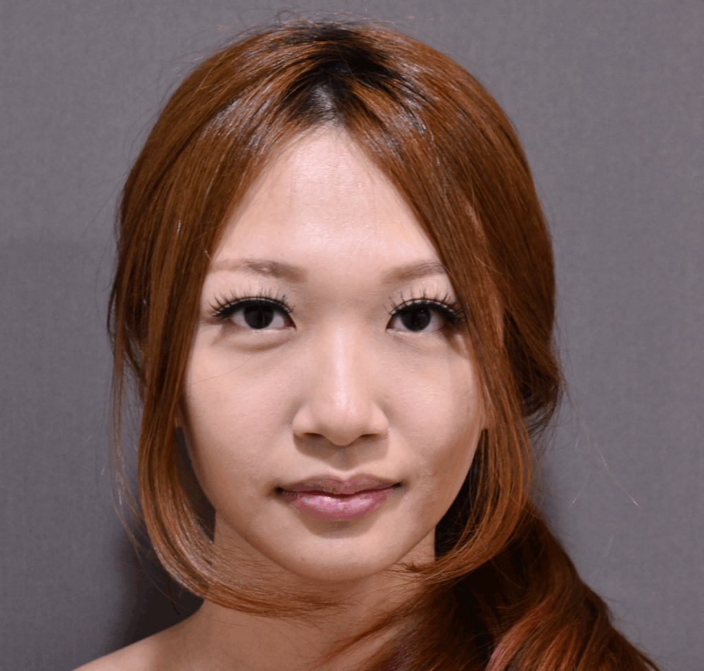 隆鼻術前：山根塌陷，五官缺乏立體時尚感1