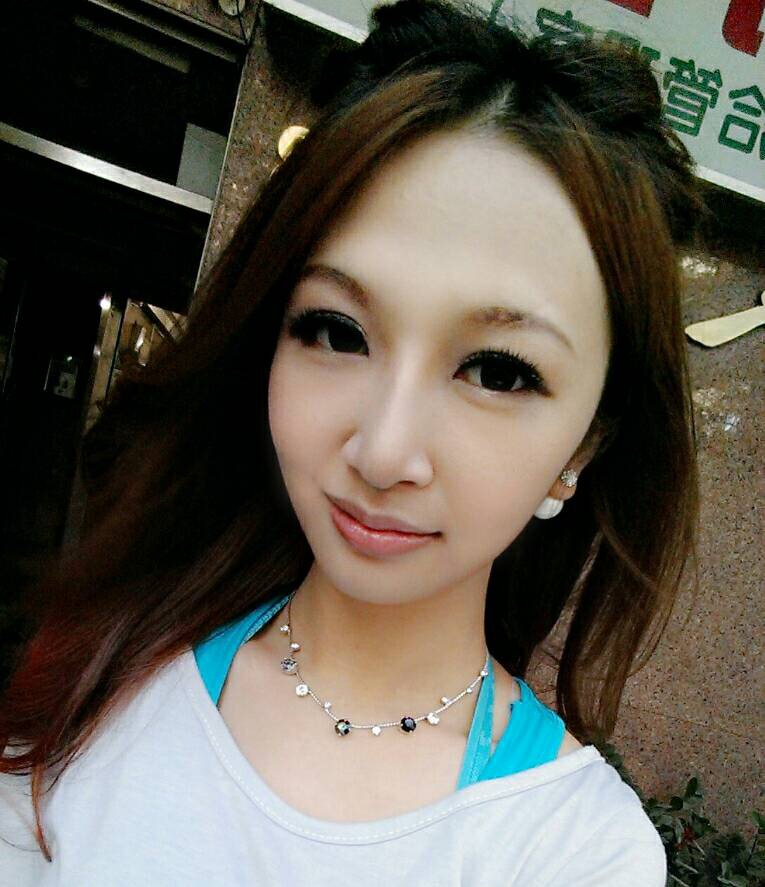 術後1個月：正面鼻型自然，側面高挺微翹1