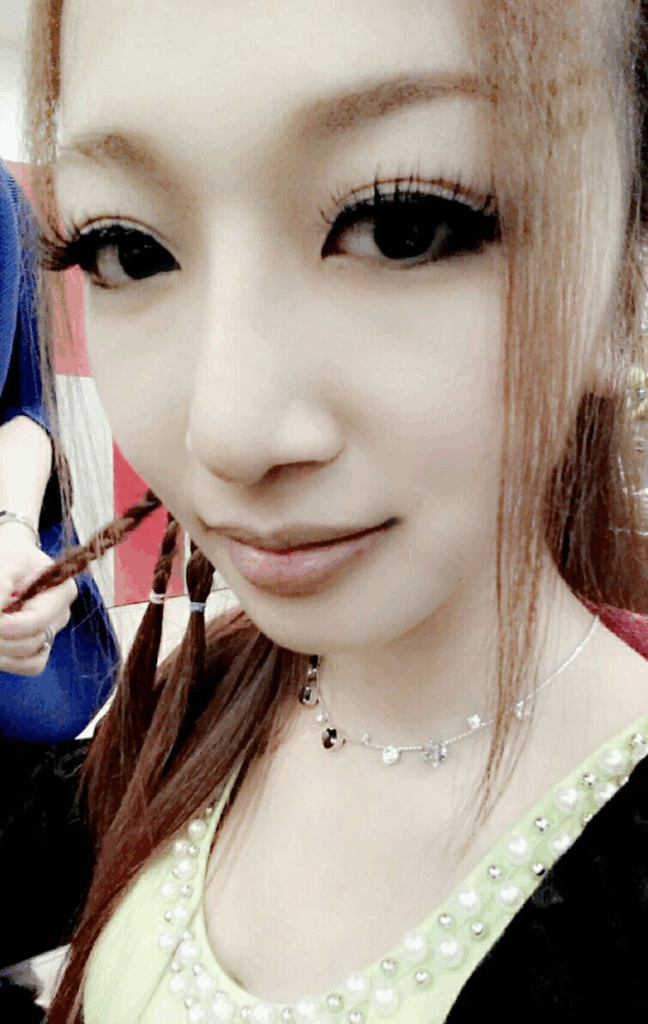 術後1個月：正面鼻型自然，側面高挺微翹2