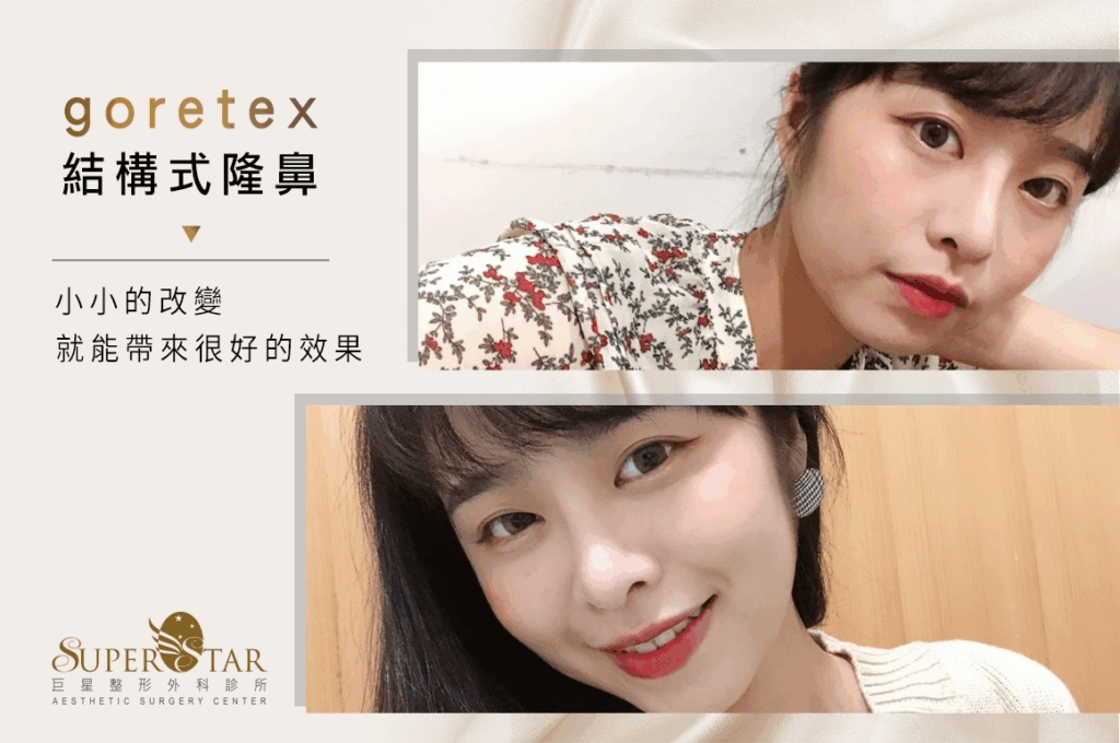 結構式隆鼻