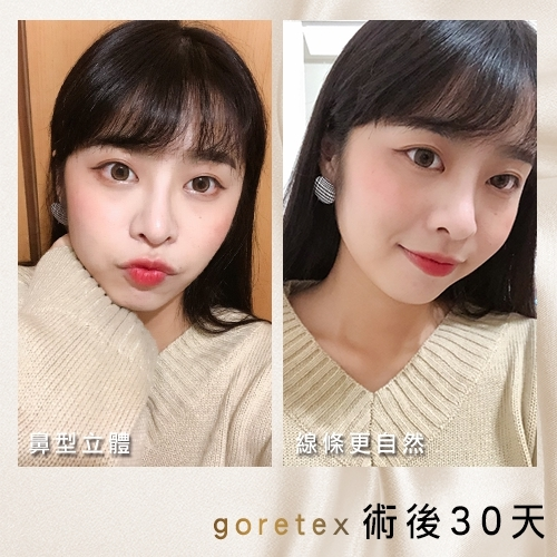 三段式隆鼻術後成果：正面側面無死角