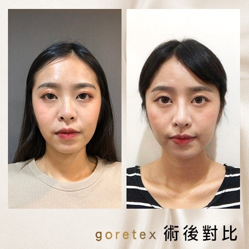 術前正面評估：塌扁鼻型與鼻孔外露