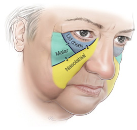 高位筋膜懸吊中下臉拉皮