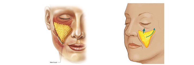 高位筋膜懸吊中下臉拉皮的優點