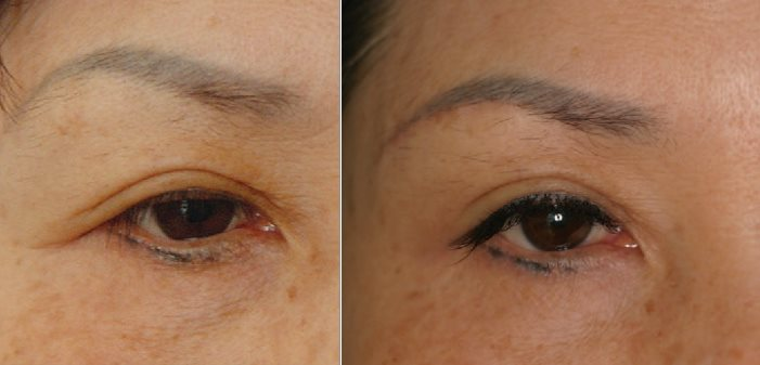 案例一：改善雙眼皮下垂 - 眉下拉皮 (眉下拉提)