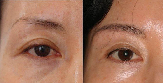 案例二：矯正三角眼 - 眉下拉皮 (眉下拉提)