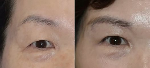 案例四：熟齡眼周改善 - 眉下拉皮 (眉下拉提)
