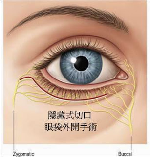眼袋外開手術 (割眼袋、除眼袋手術)