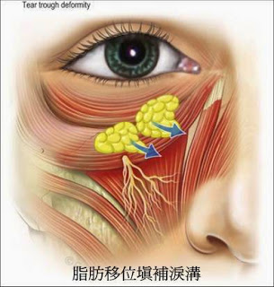 3. 眼袋外開合併補淚溝 (脂肪轉位)