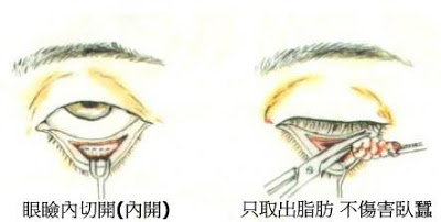眼袋內開手術流程與原理