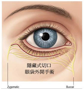 誰適合做「眼袋外開」？