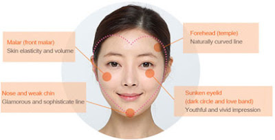 複合式眼袋內開手術 = 無痕眼袋內開 + 脂肪移位填補淚溝 + 自體脂肪豐蘋果肌