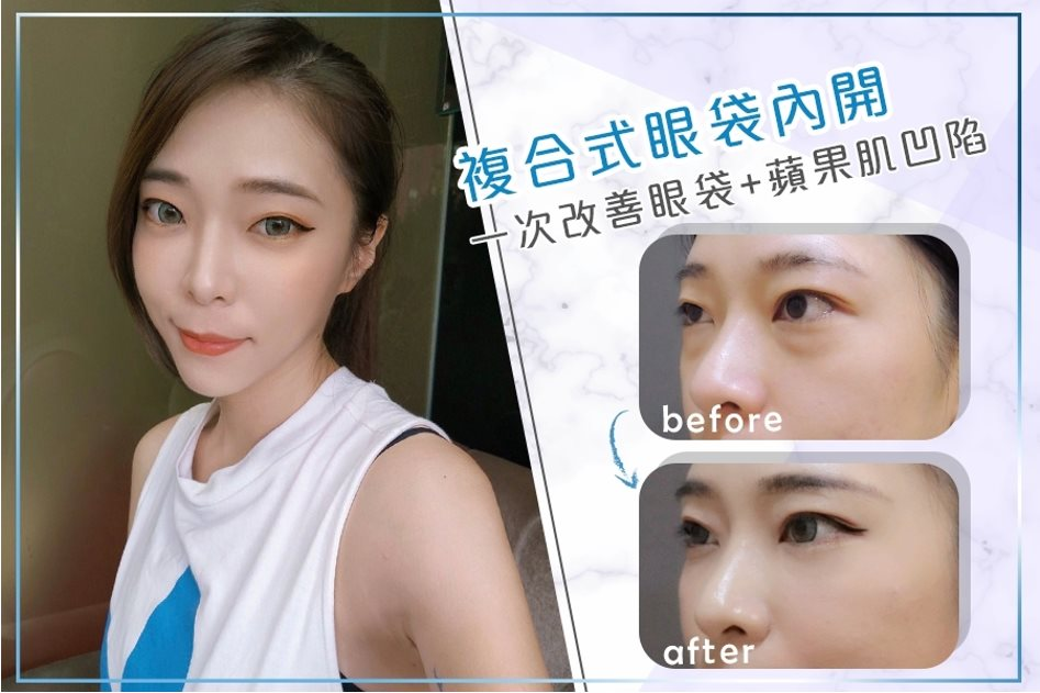 眼袋日記 1：拒當熊貓眼，找回亮麗眼神